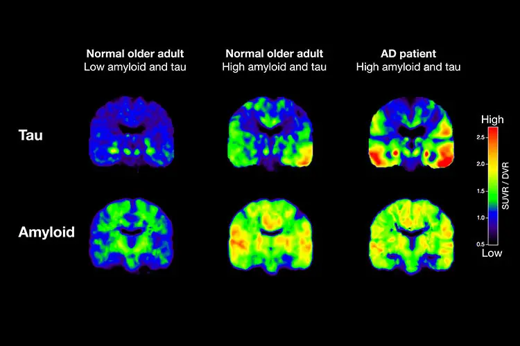 PET scans of tau and beta-amyloid for Alzheimer's disease