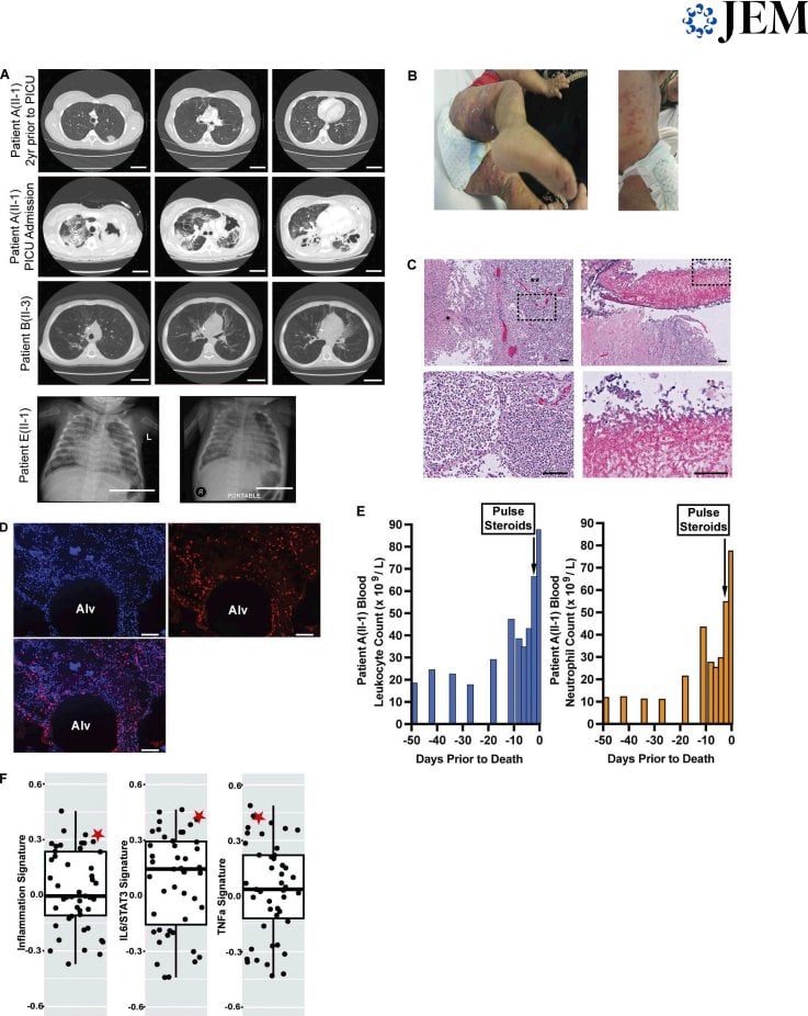 SHP1 Deficiency: A Newly Discovered Inflammatory Lung Disease and Hemolytic Anemia in Children